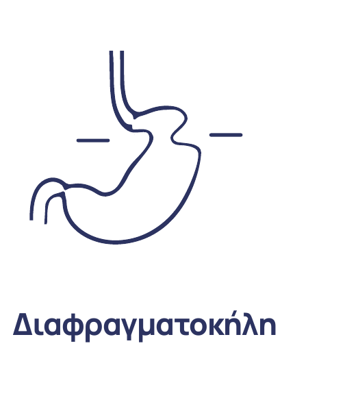 Διαφραγματοκήλη – Γαστροοισοφαγική παλινδρόμηση